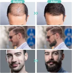 Top 10 😀 Kingsowned Dermaroller 0.5 Mm & Desinfectie Alcohol Spray - 540 Naalden - Steriel Verpakt 🎉 -Beauty Winkel 550x554 9