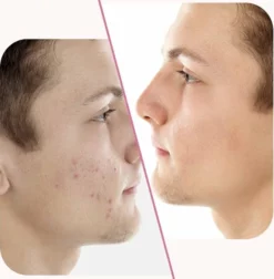 Beste deal ✔️ Merkloos Pimple Patch - Acne Patch - Puisten Patch - Acne Sticker - Puisten Pleister - Pimple Patches - Acne Pleister - Puisten Verwijderaar - Puisten Creme - Acne Verwijderen Set - Acneverzorging | 36 Stuks & Directe Levering 🛒 -Beauty Winkel 550x561 7